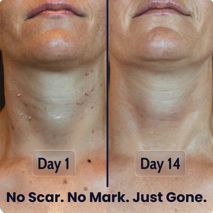 Skin Tag Cryo Recovery Spray